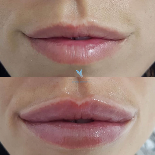 Aumento de labios